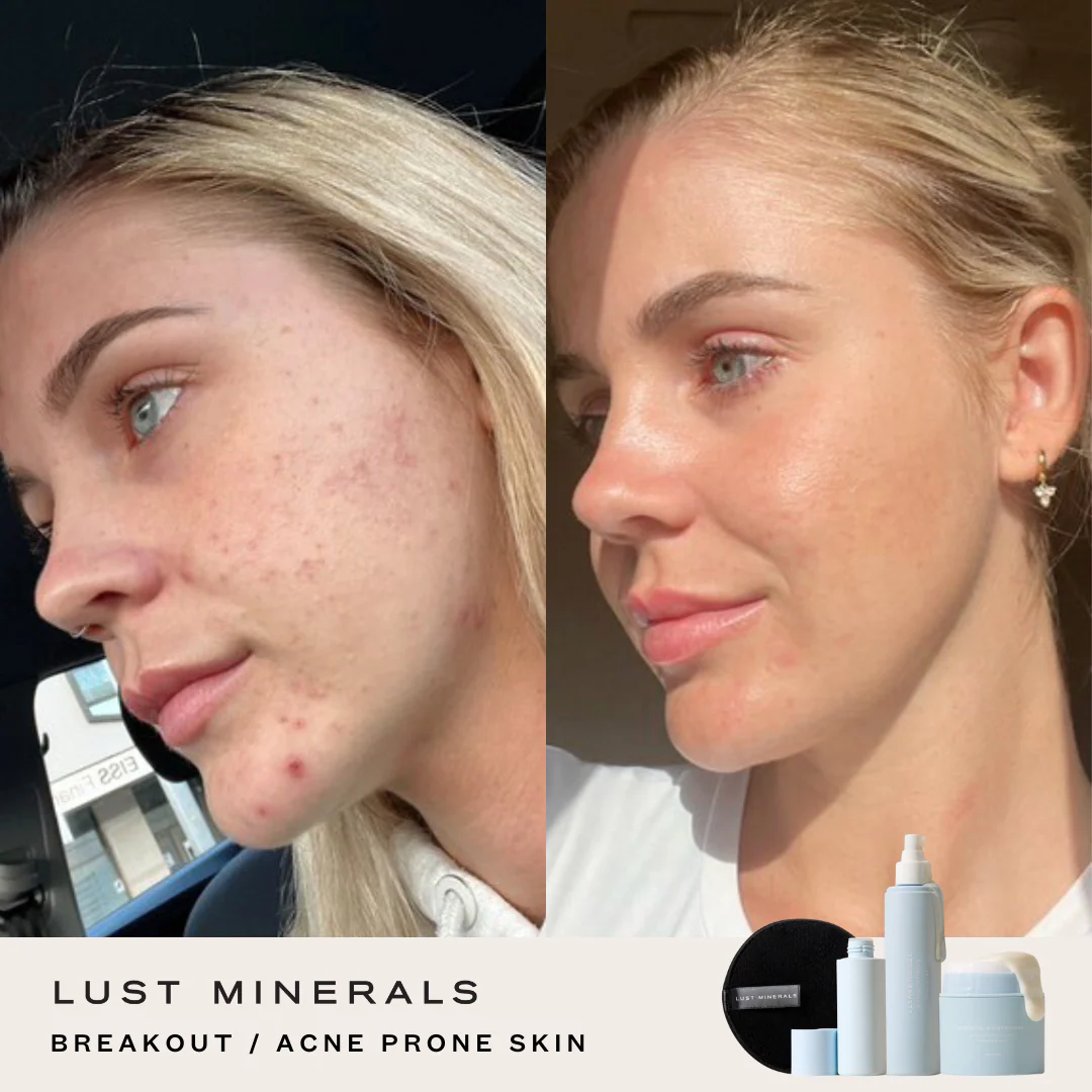 Teen Skincare System - Image 3