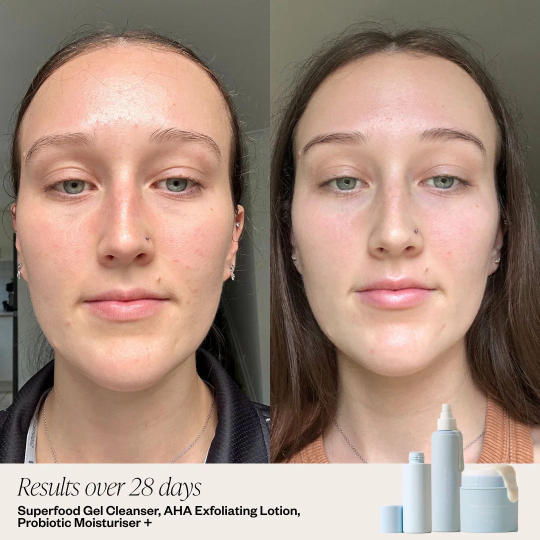 Teen Skincare System - Image 4